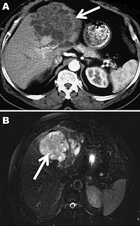 200px-Polycystic_echinococcosis_affecting_the_left_side_of_the_liver.jpg