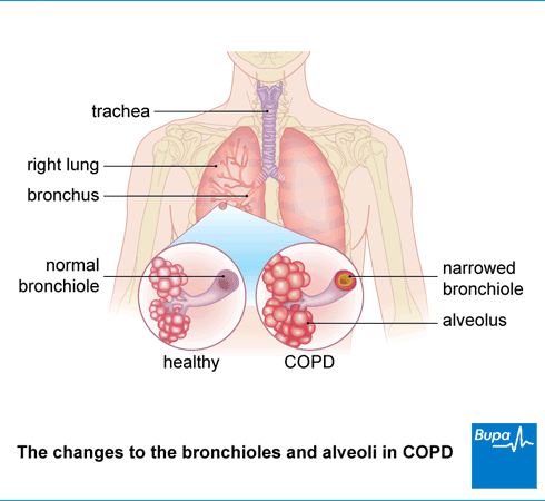COPD-changes-to-bronchioles-and-alveoli.png